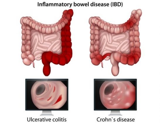 inflammatory bowel disease symptoms