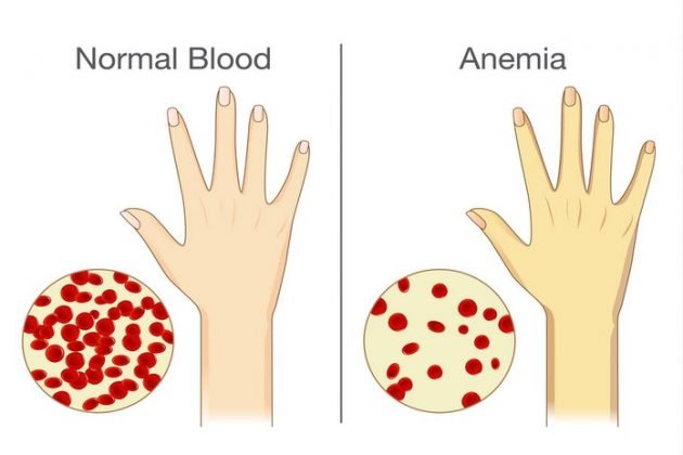 Anemia Overview Symptoms Causes Types And Dietary Guidelines Betahealthy 3570