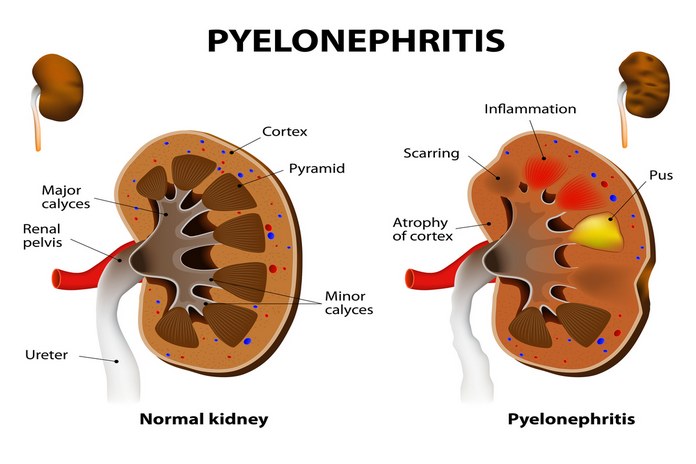 Пиелонефрит риски. Pyelonephritis Symptoms. Causes of secondary Pyelonephritis.