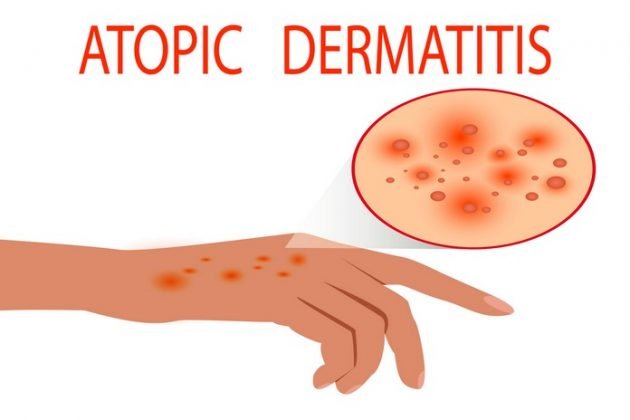A Comprehensive Guide To Atopic Dermatitis - Beta Healthy