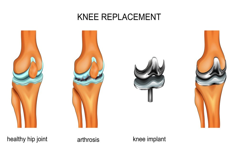 Total Knee Replacement Surgery: What To Know and What To Expect