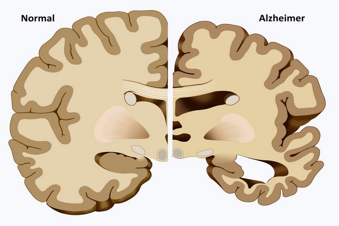 7 Stages of Alzheimer's Disease