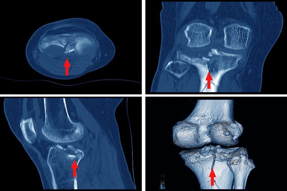 Computerized Tomography (CT) Scans