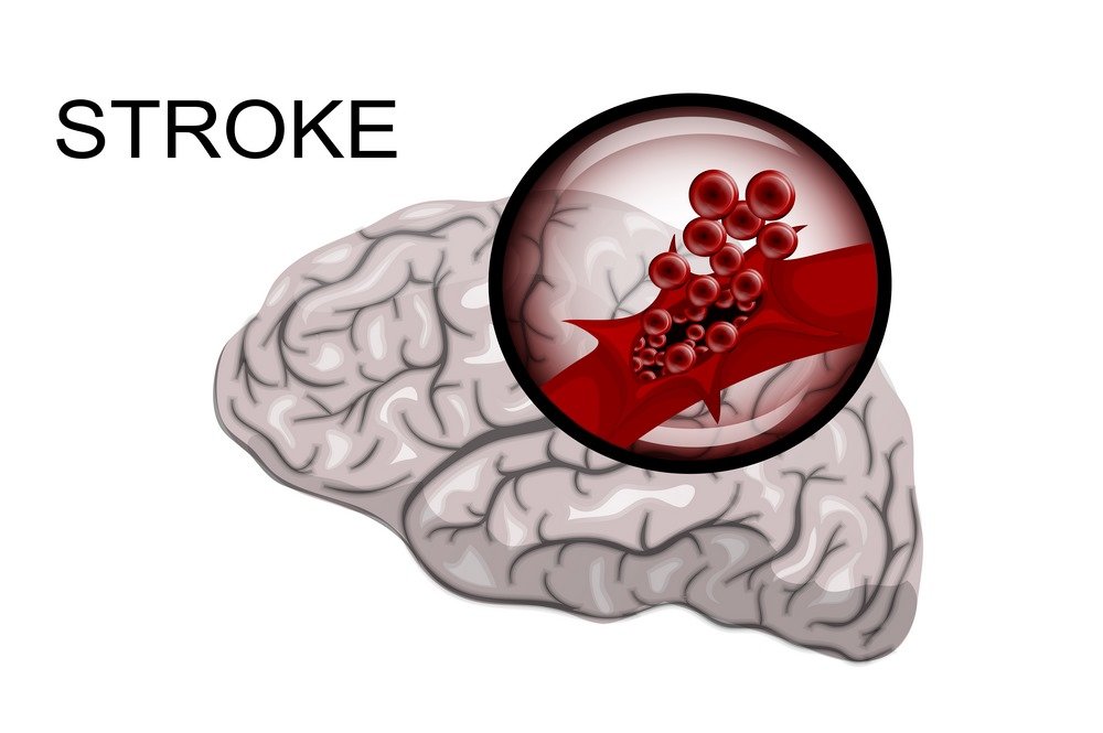 Cryptogenic stroke