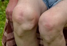 Deformities Of The Knee