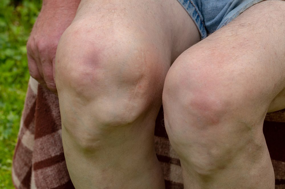 Deformities Of The Knee