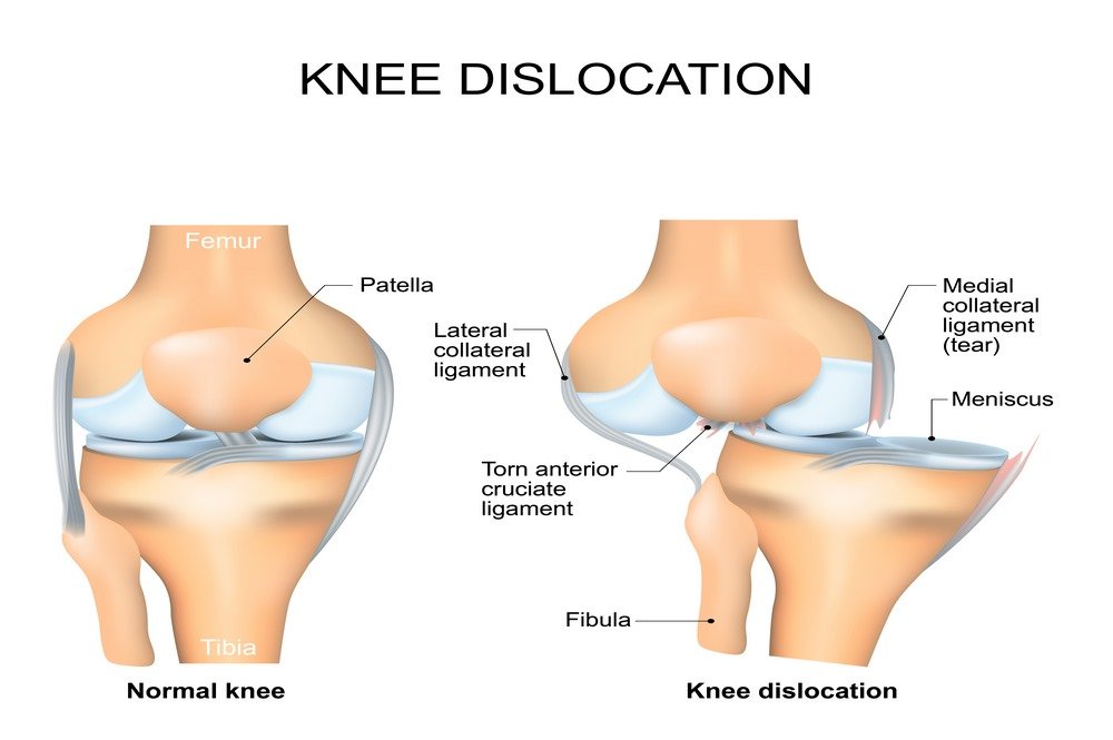 Dislocation Injuries