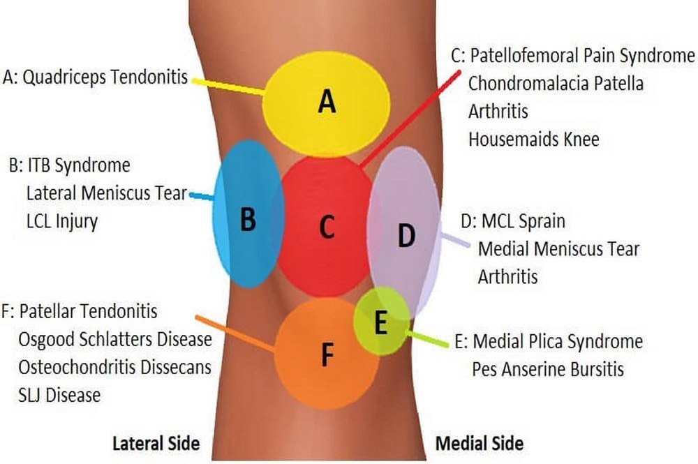 Front Knee Pain Diagnosis Chart