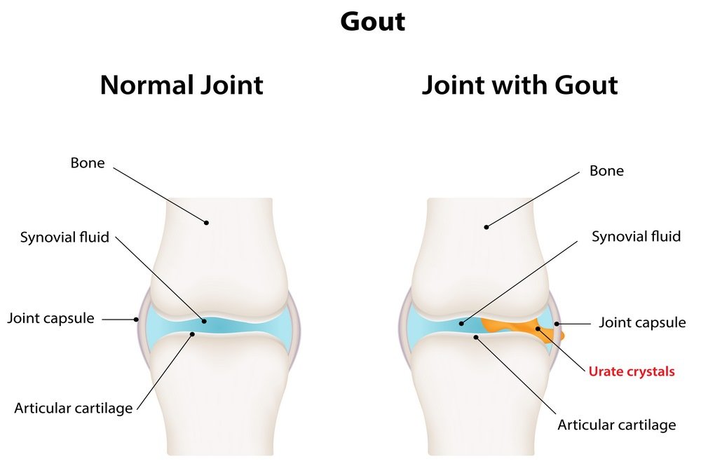Gout and Pseudo-Gout