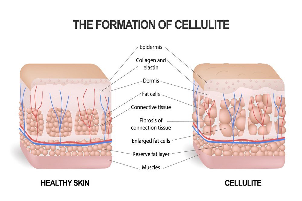Histophysiological signs of cellulite