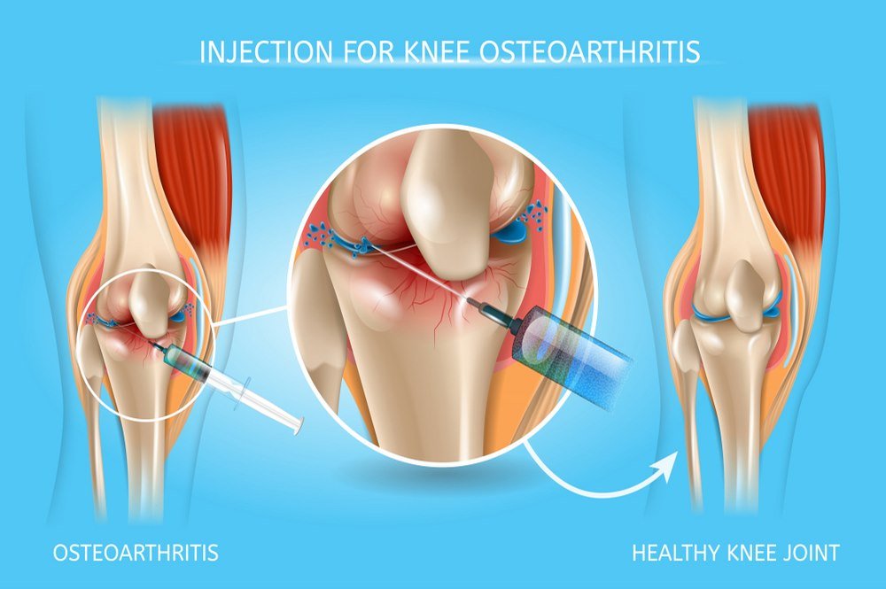 Injections For Knee Osteoarthritis