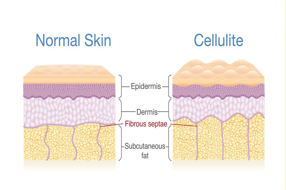 Is cellulite a medical issue?