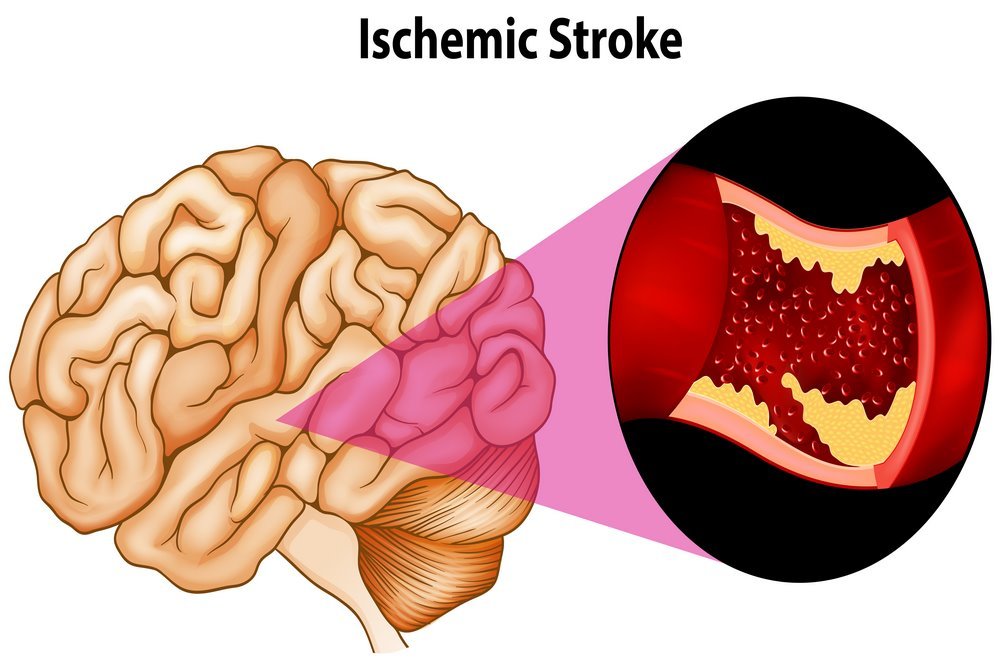 Types of stroke