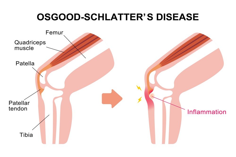 Osgood-Schlatter’s Disease