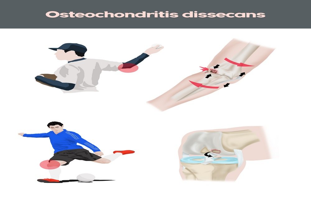 Ostoechondritis Dissecans (OCD)