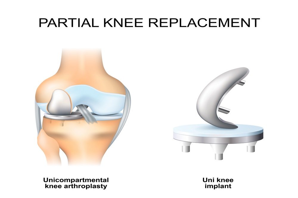 Partial,Knee,Replacement.,Unicompartmental,Knee,Arthroplasty,And,Uni,Knee,Implant