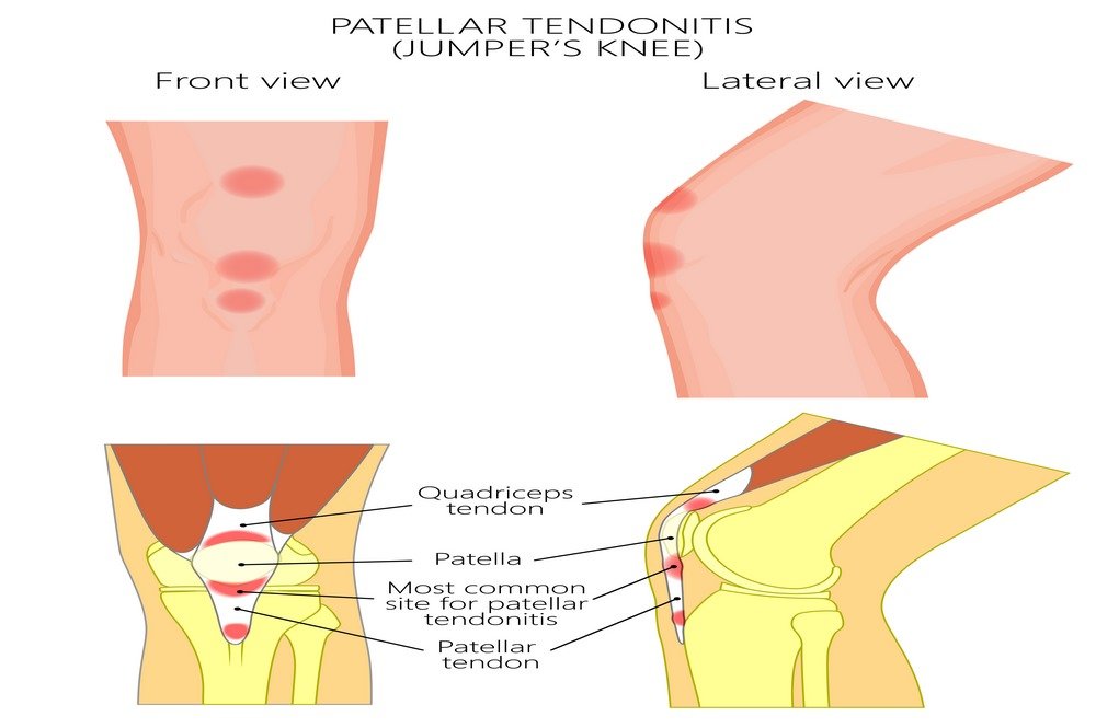 Patellar Tear and Tendonitis
