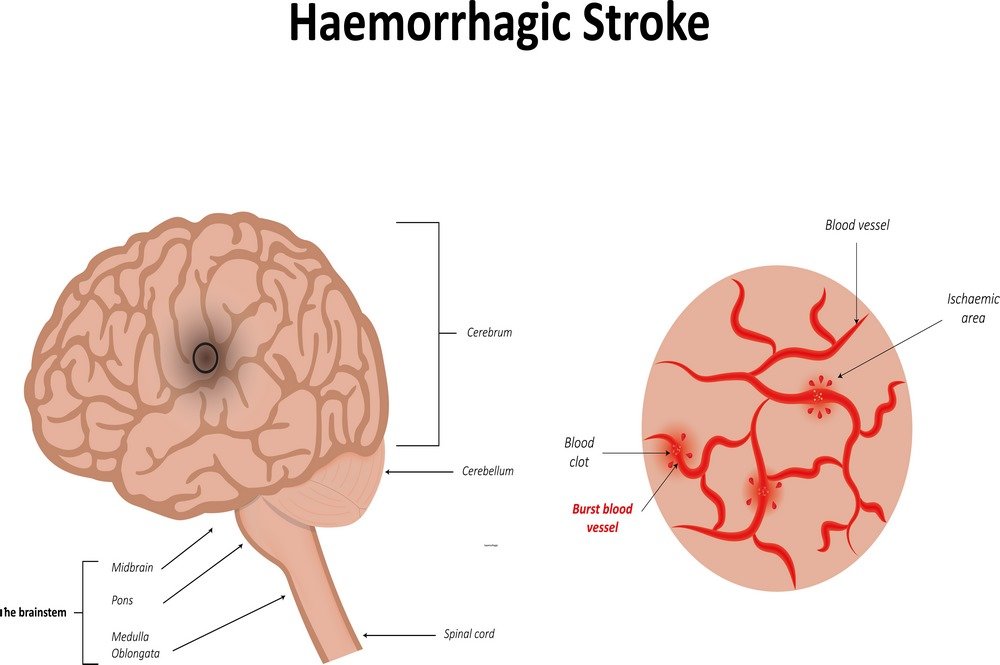Pathophysiology of hemorrhagic stroke