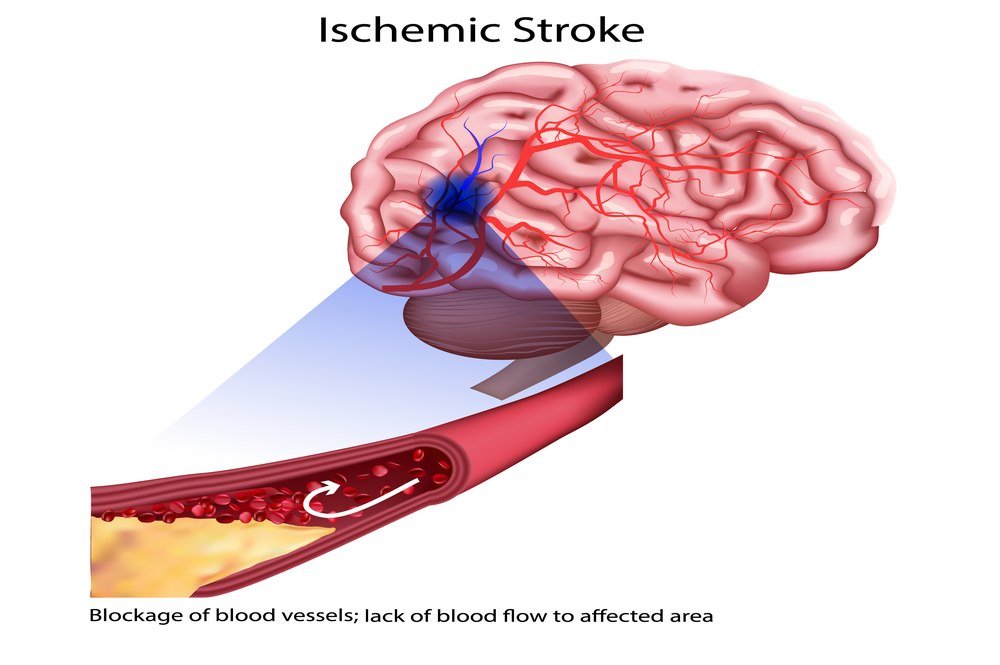 Pathophysiology of stroke