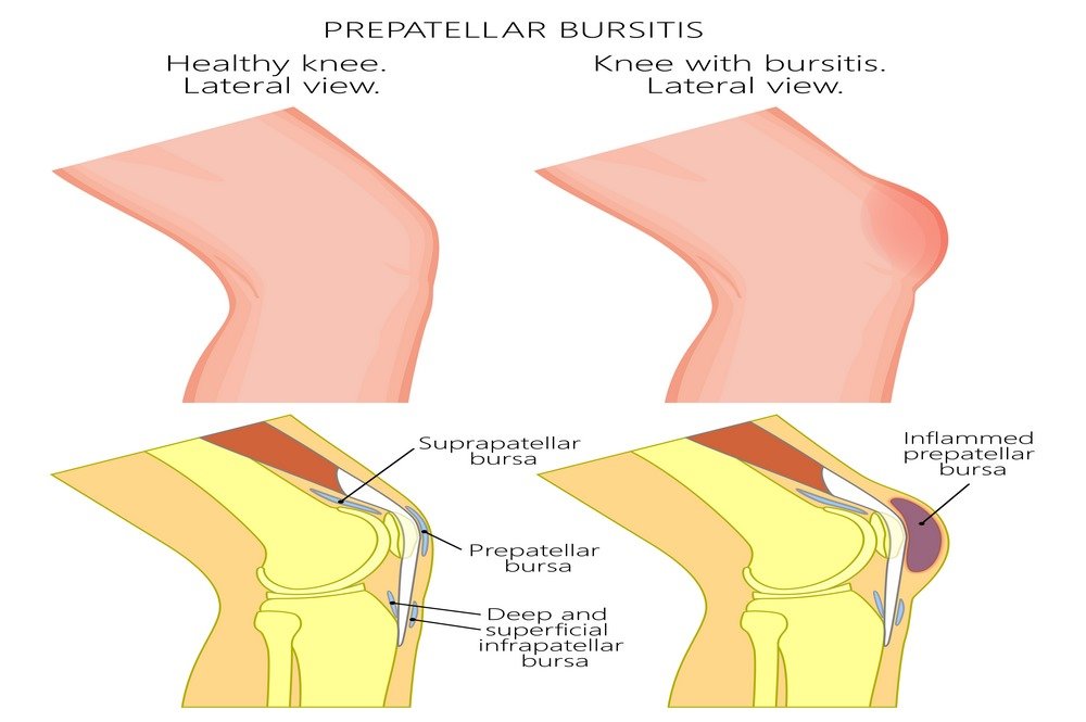 Prepatellar Bursitis