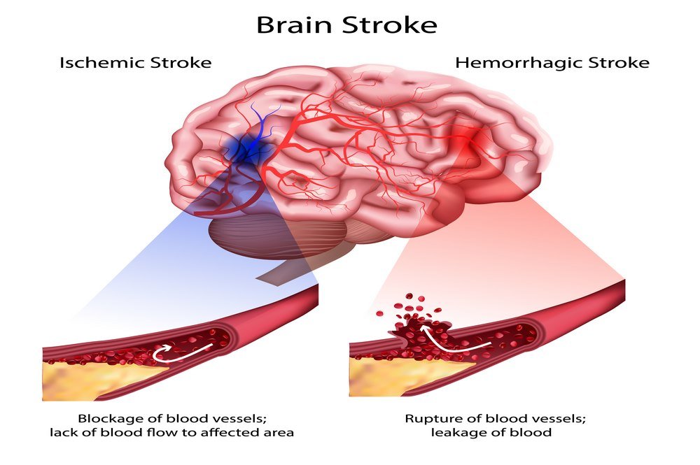 Previous stroke