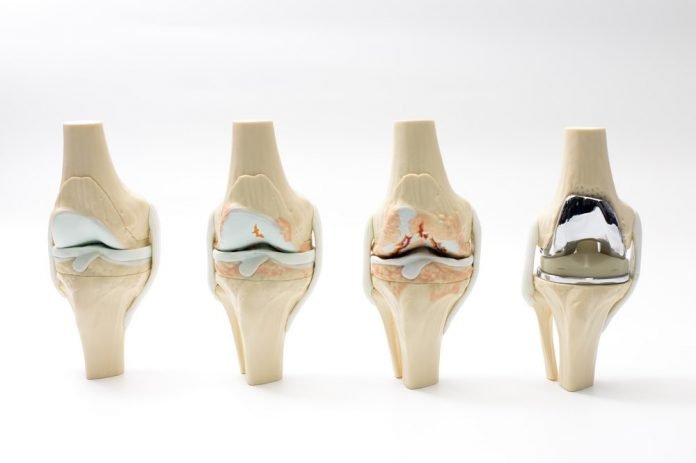 Reasons For Knee Replacement Surgery
