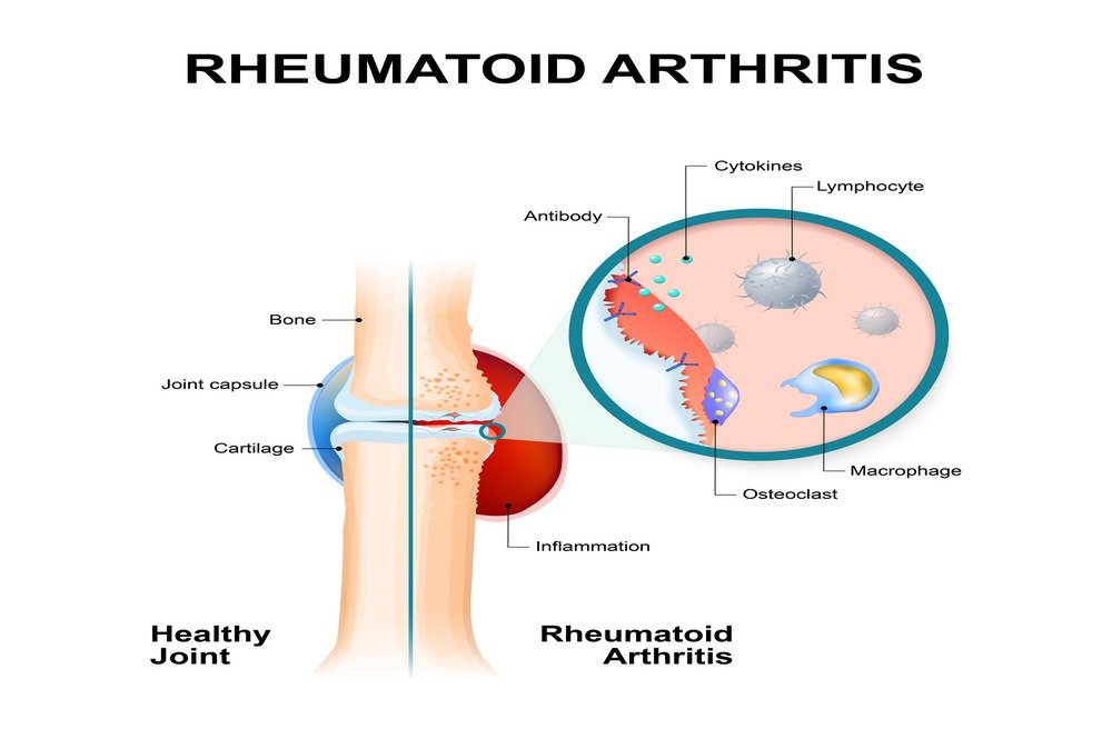 Knee Rheumatoid Arthritis