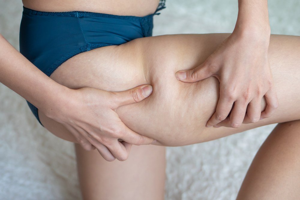 Signs and Symptoms of Cellulite