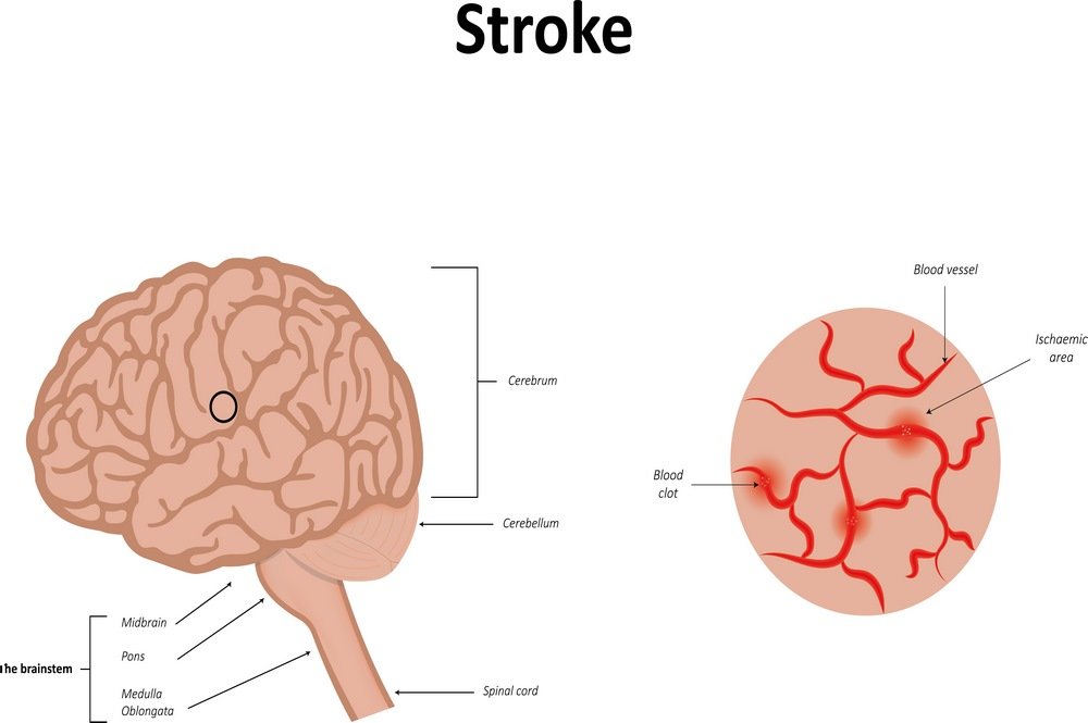 Transient ischemic stroke 