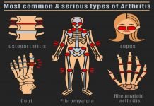Common Types Of Arthritis That Affect The Knee