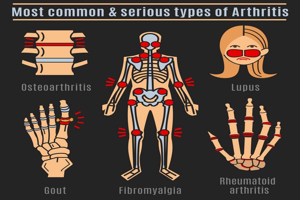 Common Types Of Arthritis That Affect The Knee