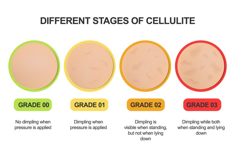 Types of cellulite