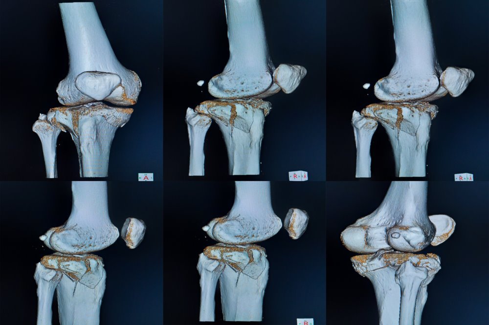 What are the complications of inner knee injuries?