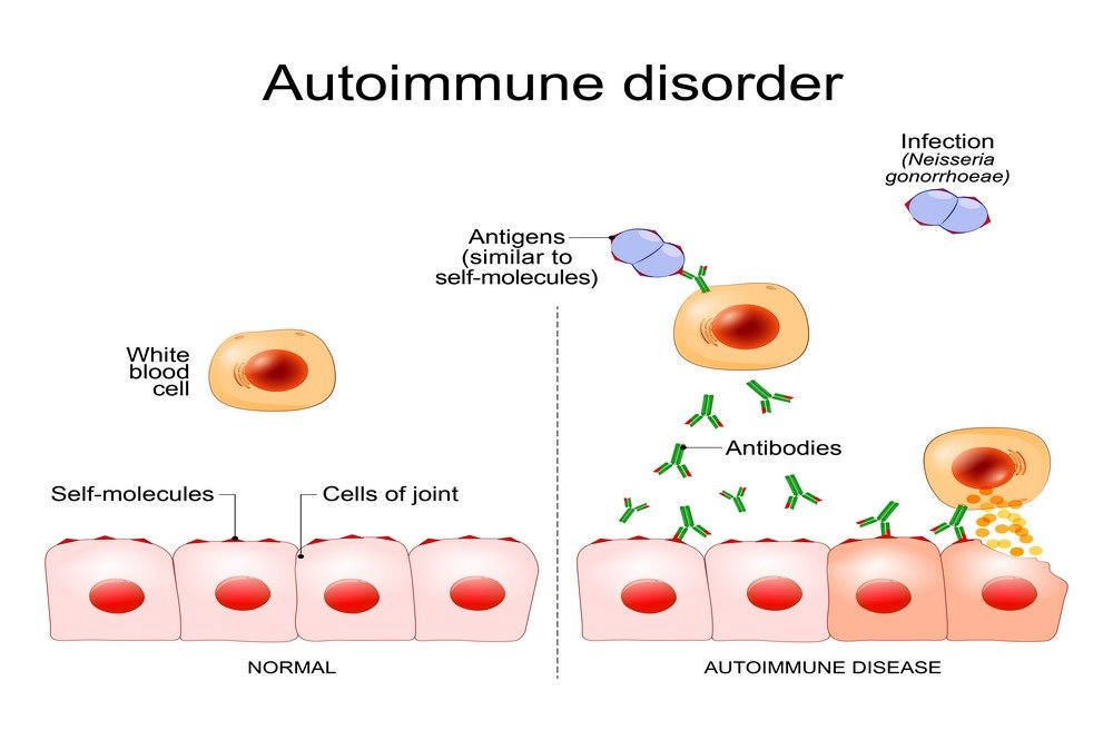 Autoimmune disorders