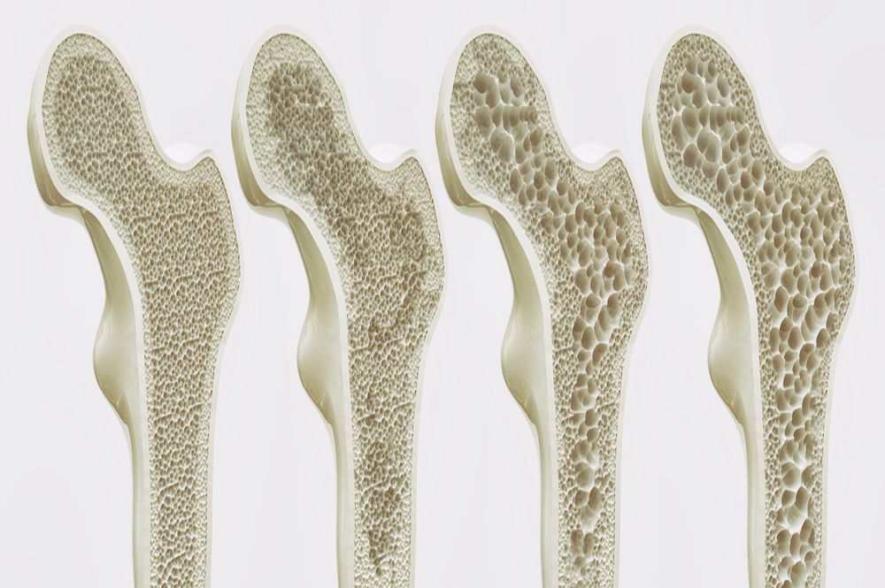 Bone structural changes in osteoporosis