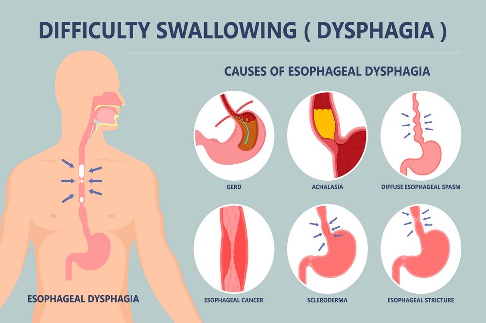 Difficulty in swallowing (Dysphagia)
