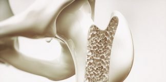 Facts and figures about osteoporosis