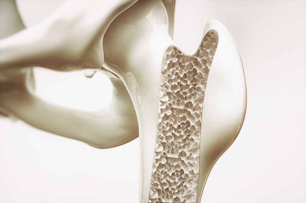 Facts and figures about osteoporosis
