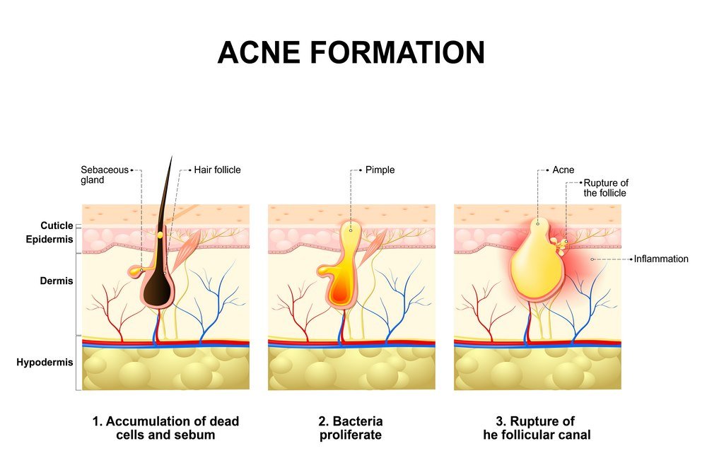 Myths related to acne