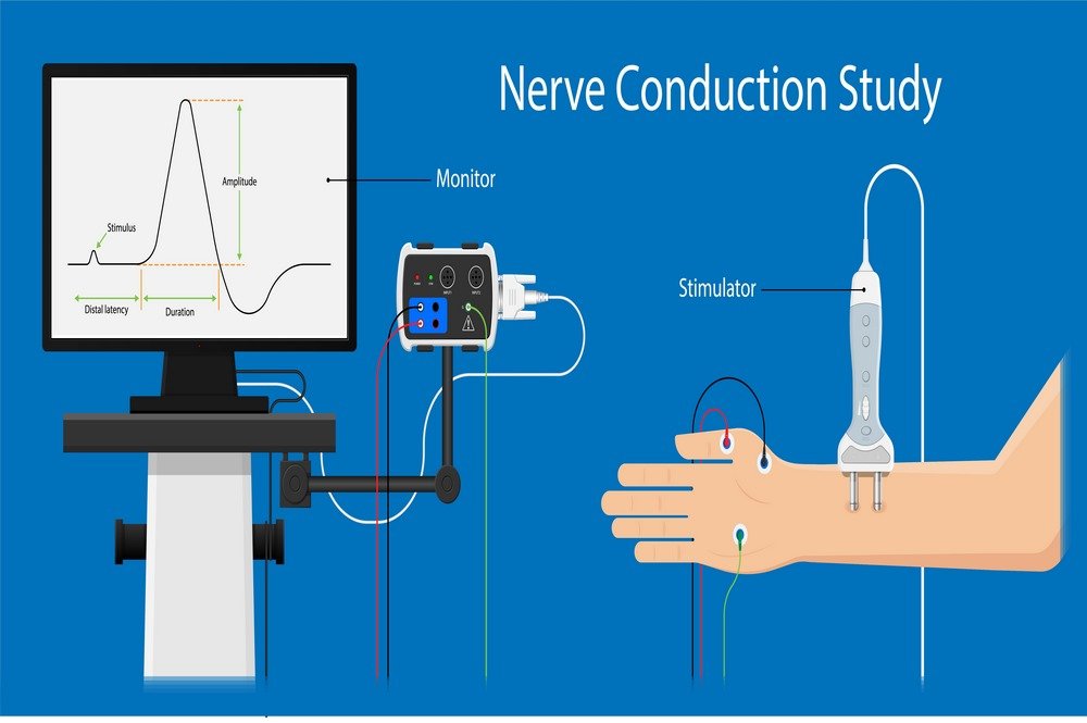 Repetitive nerve stimulation test