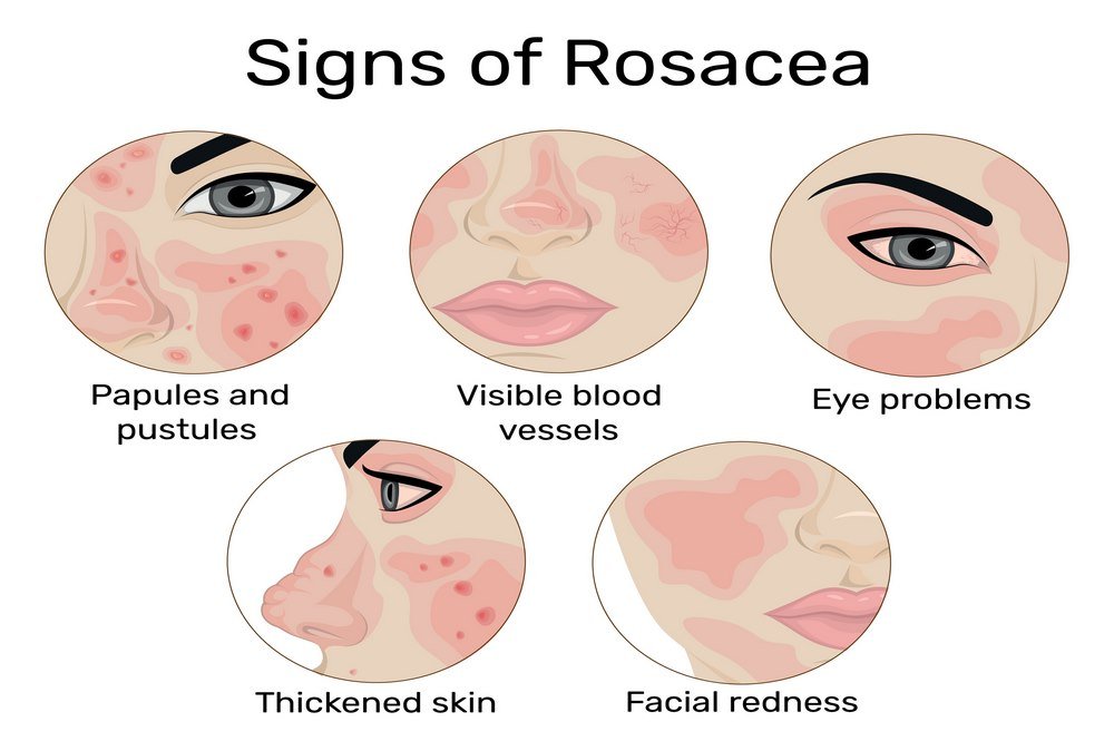 Symptomatic differentiation from rosacea