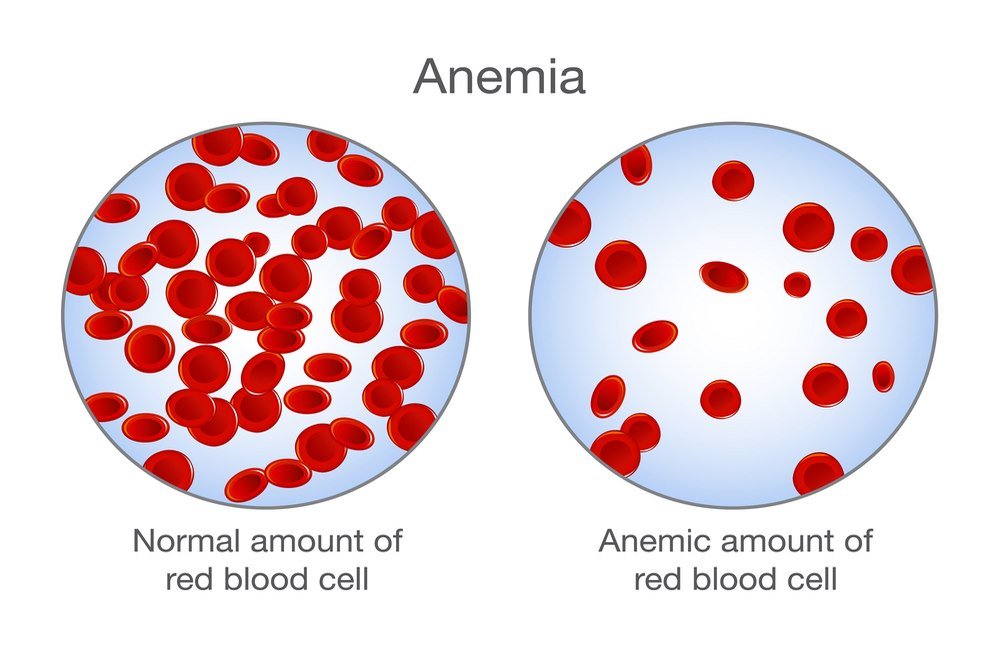 Anemia 