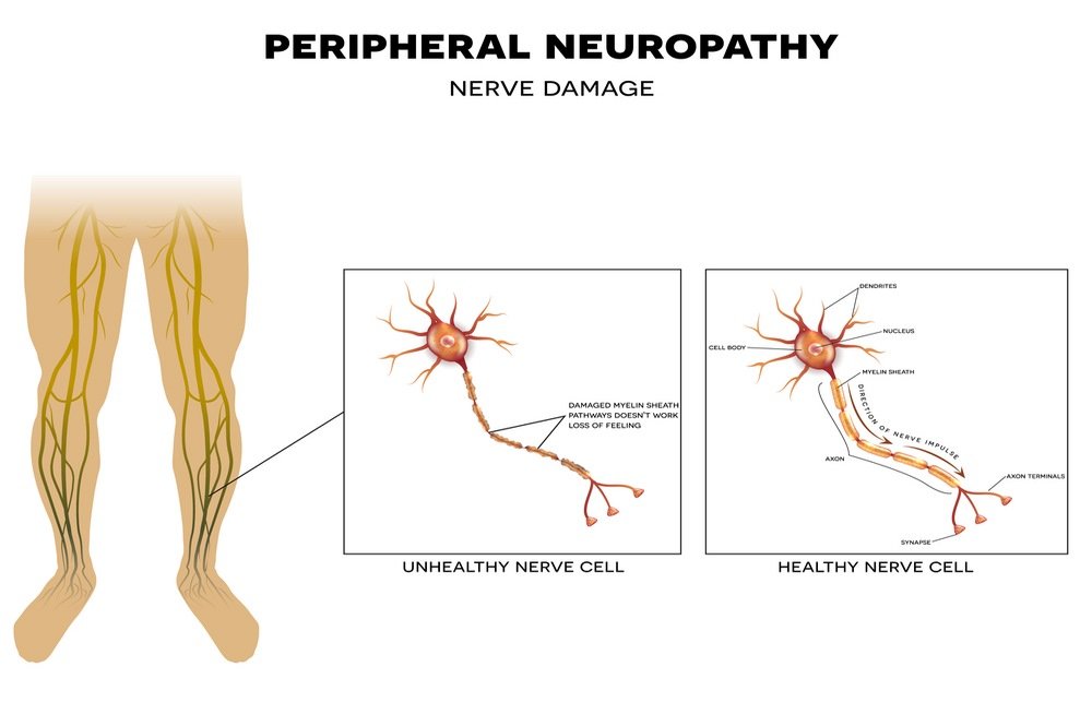 Peripheral neuropathy and other nerve problems