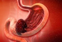Stomach Cancer : Symptoms, Causes, Stages, Diagnosis, Survival Rate, Cure and Treatment