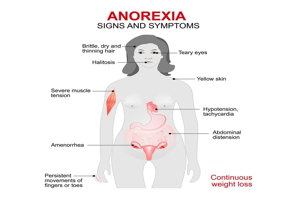Symptoms of anorexia nervosa