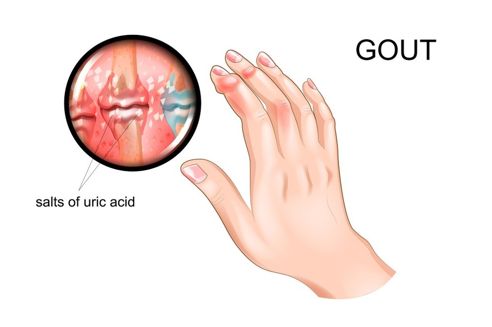 Acute gout