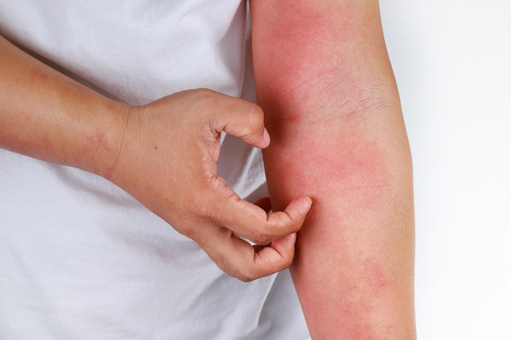 Allergic eczema