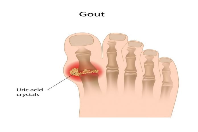 Signs and Symptoms Of Gout