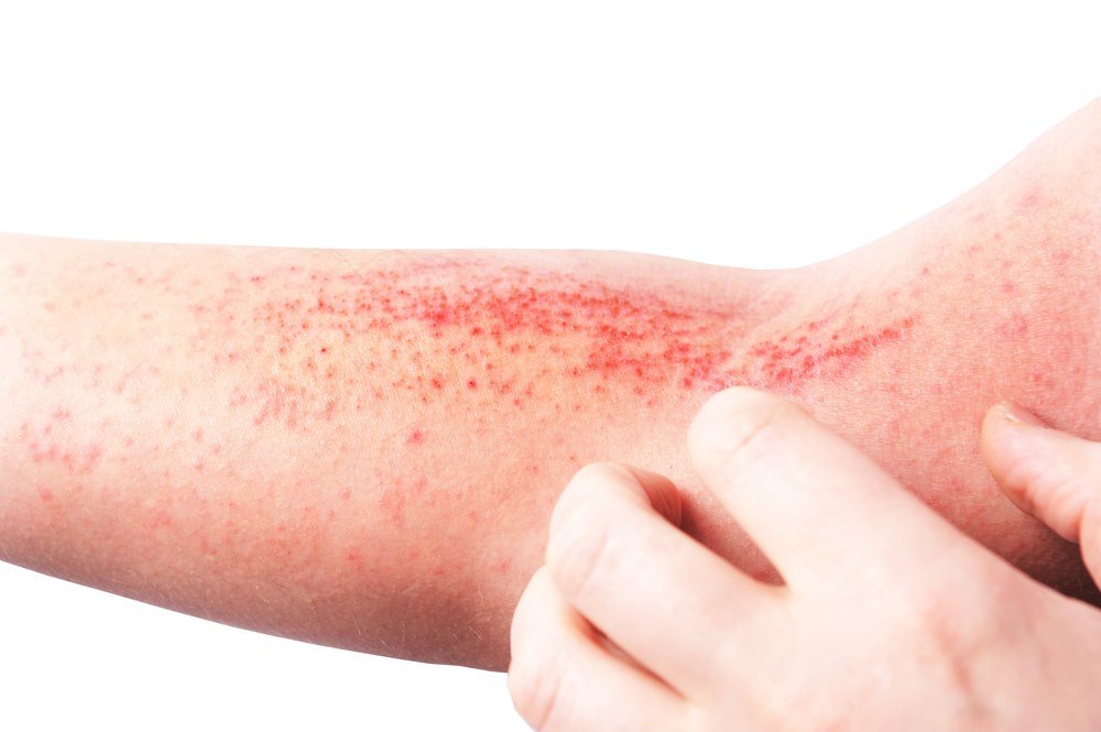 Types Of Skin Rashes