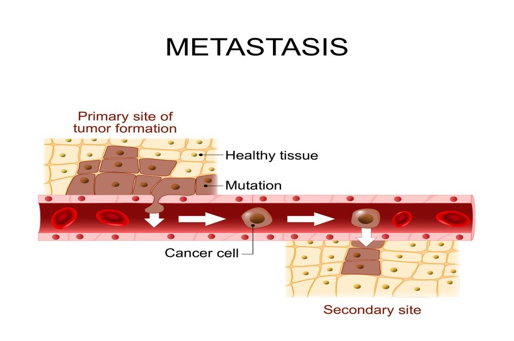 Cancer metastasis